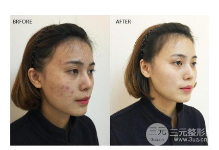 彩光去雀斑會(huì)結(jié)痂嗎