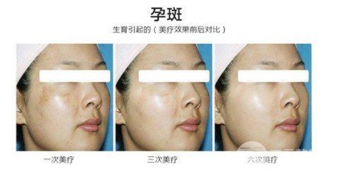 彩光去雀斑會(huì)結(jié)痂嗎