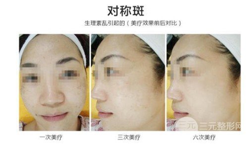 彩光去雀斑會(huì)結(jié)痂嗎