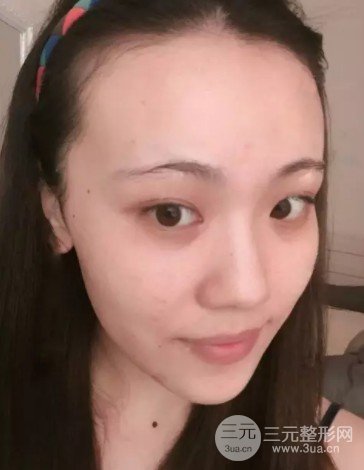 彩光去雀斑會(huì)結(jié)痂嗎