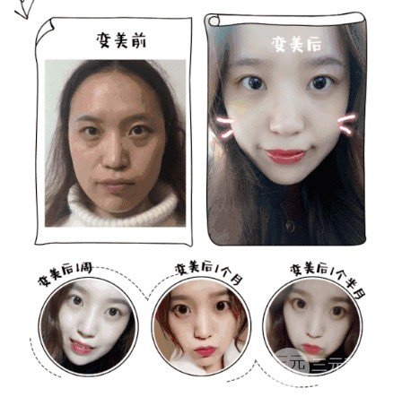 超聲波去眼袋哪里有