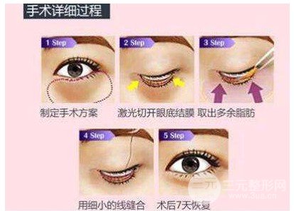 超聲波去眼袋哪里有