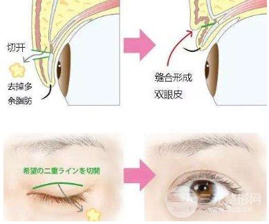 雙眼皮全切過程