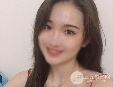 雙眼皮全切過程