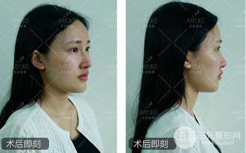 玻尿酸美容果真的好嗎