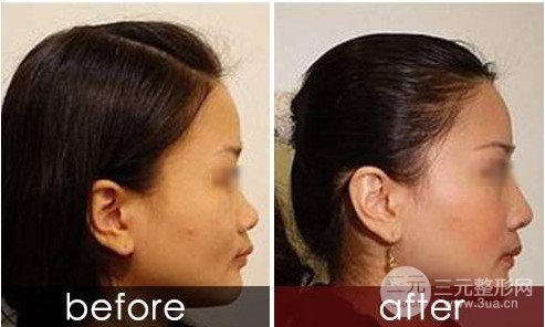 玻尿酸美容果真的好嗎