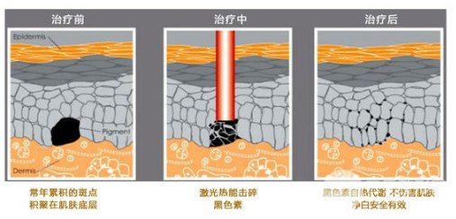 如何去除臉上黃褐斑