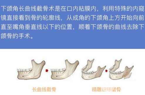 磨骨手術風險大么