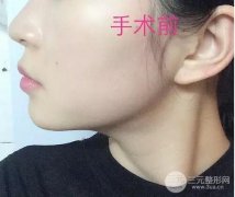 墊下巴前后對(duì)比果圖發(fā)布，小V臉的精髓就在這里啦！