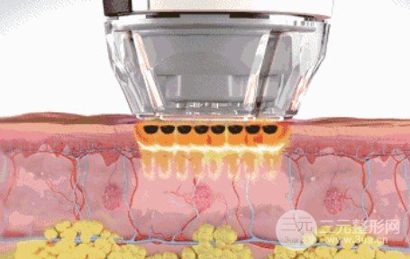 oe光子嫩膚的價(jià)格和果