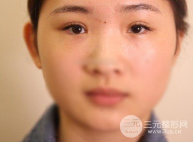 眼角開(kāi)大整形手術(shù)
