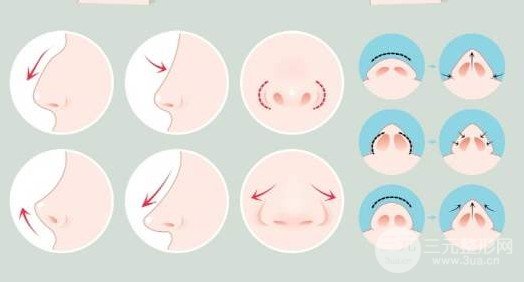 鼻翼整形要多少錢