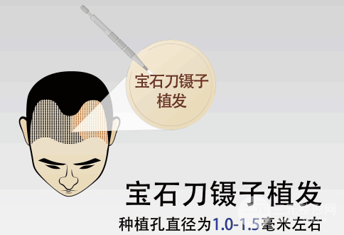 2020年度深圳植發(fā)醫(yī)院排行