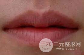 M唇手術(shù)的果怎么樣?