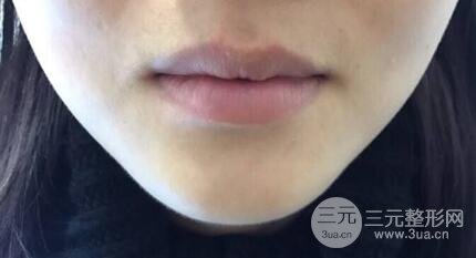 M唇手術(shù)對(duì)比照：