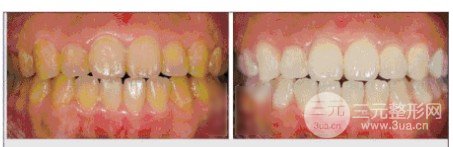 冷光美白牙齒好不好