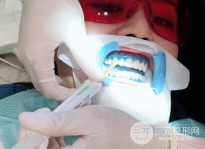 冷光美白牙齒好不好