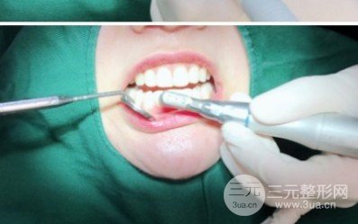 冷光美白牙齒好不好