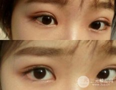 做雙眼皮的方法【大全】，決定做雙眼皮前看一看!