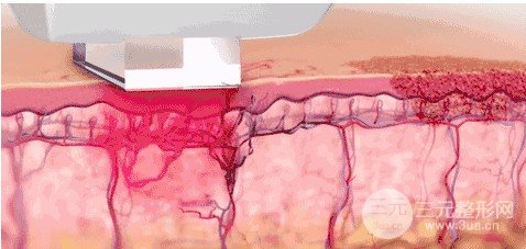 光子嫩膚多久做一次