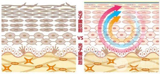 光子嫩膚多久做一次