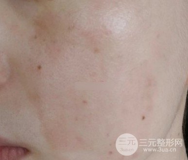 黃褐斑緩解費用高不高