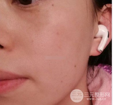 黃褐斑緩解費用高不高