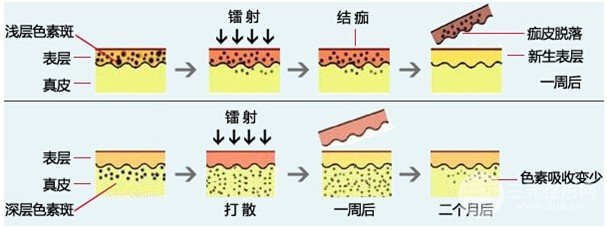 激光可以去除黃褐斑嗎