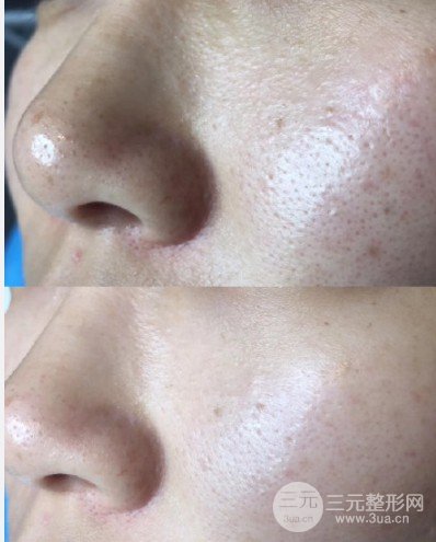 黑臉娃娃嫩膚疼嗎