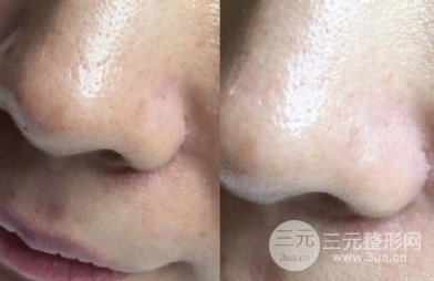 黑臉娃娃嫩膚疼嗎