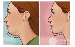 怎么樣瘦雙下巴?除了運(yùn)動(dòng)有什么快速的方式嗎?