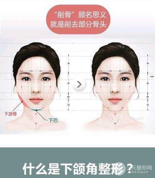 國(guó)字臉削骨價(jià)格一般多少錢？手術(shù)注意事項(xiàng)以及案例圖分享~