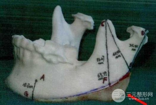 國(guó)字臉削骨價(jià)格一般多少錢？手術(shù)注意事項(xiàng)以及案例圖分享~