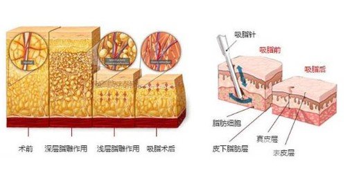 吸脂好不好