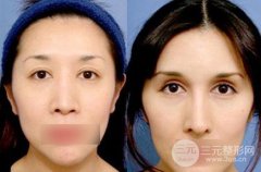 做雙眼皮開眼角新手注意事項，手術(shù)果多圖