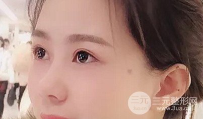 做雙眼皮開眼角注意事項