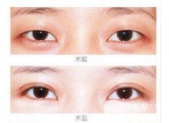 什么是微創(chuàng)雙眼皮手術(shù)?真的微創(chuàng)么—來看真人果圖