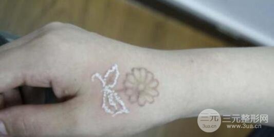 洗紋身事項(xiàng)問(wèn)與答：