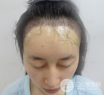 額頭太高了怎么改良變低