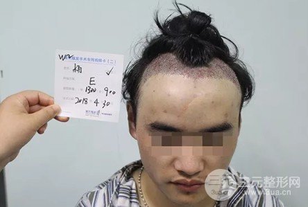 額頭太高了怎么改良變低