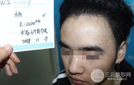 額頭太高了怎么改良變低