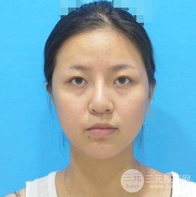 割雙眼皮真人案例