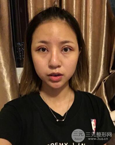 割雙眼皮真人案例