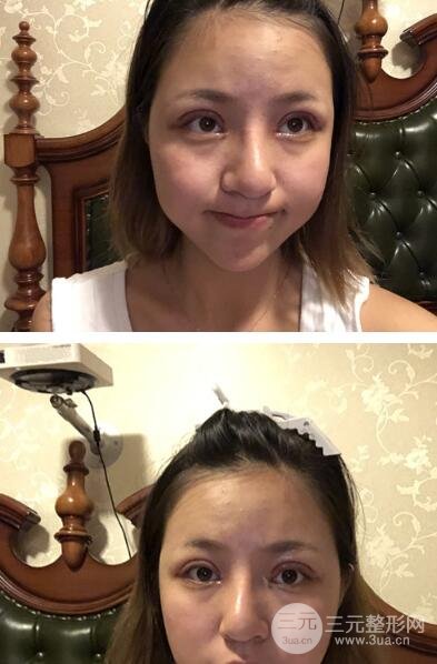 割雙眼皮真人案例