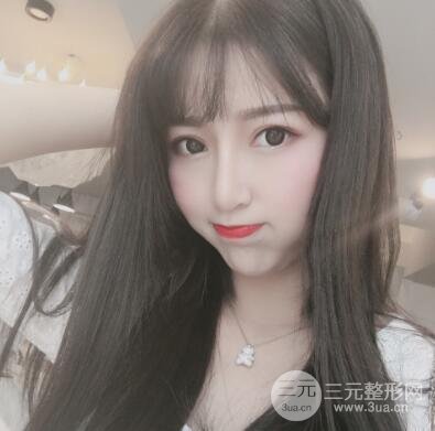 割雙眼皮真人案例