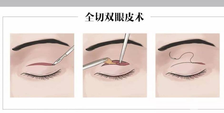 定位雙眼皮和全切的區(qū)別