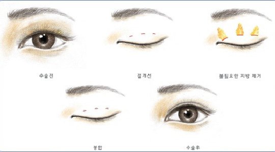 定位雙眼皮和全切的區(qū)別