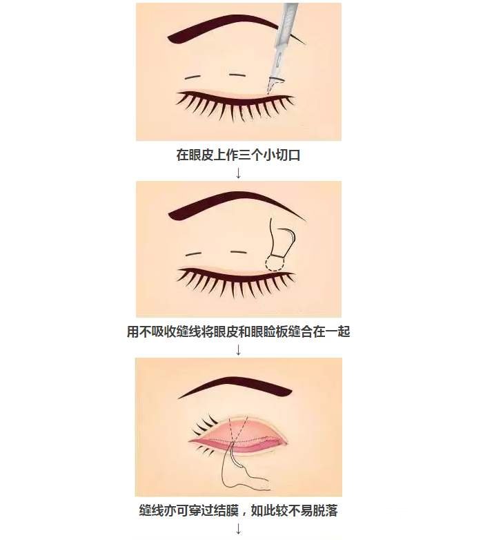 定位雙眼皮和全切的區(qū)別