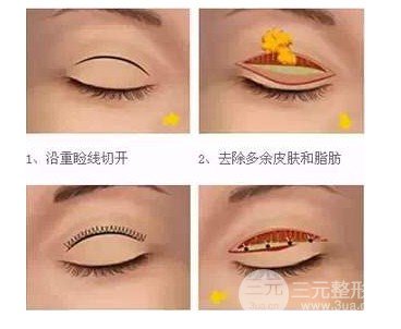 雙眼皮手術(shù)疼嗎