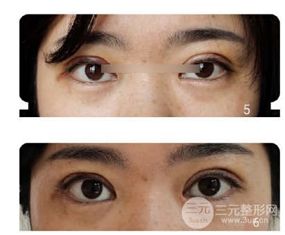 雙眼皮手術(shù)疼嗎